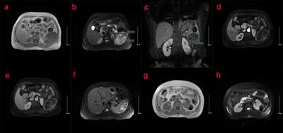 A Primary Extraskeletal Osteosarcoma of the Spleen: Rare Case Report